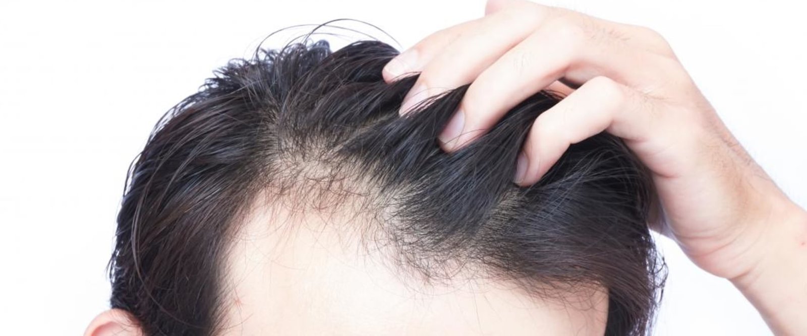Can permanent hair loss grow back?