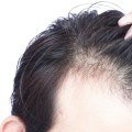 Is hair loss from not eating permanent?